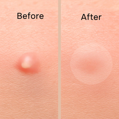 Parches para Acne